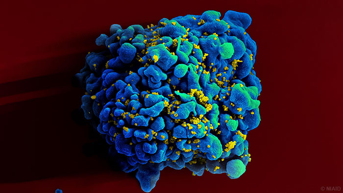 ״ηֱԱȾHIV